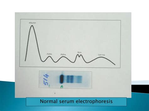 Ppt Serum Protein Electrophoresis Powerpoint Presentation Free