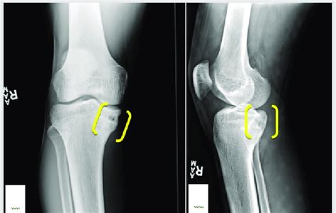 Final Anteroposterior Radiograph Of The Right Knee Taken 3 Months After Download Scientific