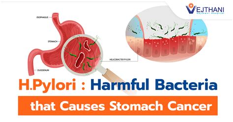 H.Pylori: Harmful Bacteria that Causes Stomach Cancer - Vejthani ...