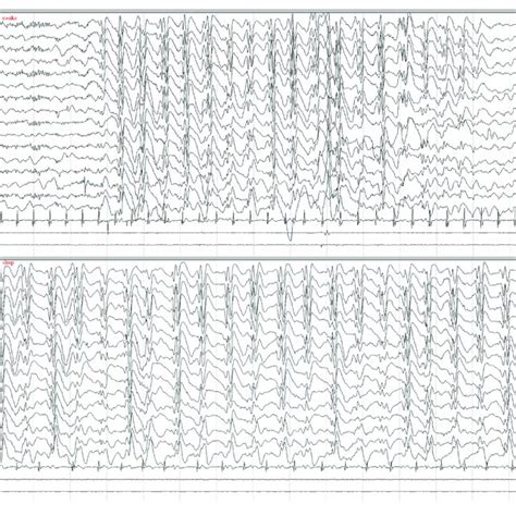 Eeg Demonstrated Generalized Slow Spike And Wave Complexes 1 6 2 Hz