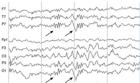 EEG Board Prep 2 Flashcards Quizlet