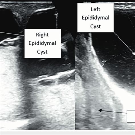 Scrotal Ultrasonography Images Showing Two Large Cystic Swellings