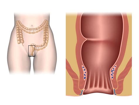 Unc Rex Colorectal Raleigh Transanal Endoscopic Microsurgery