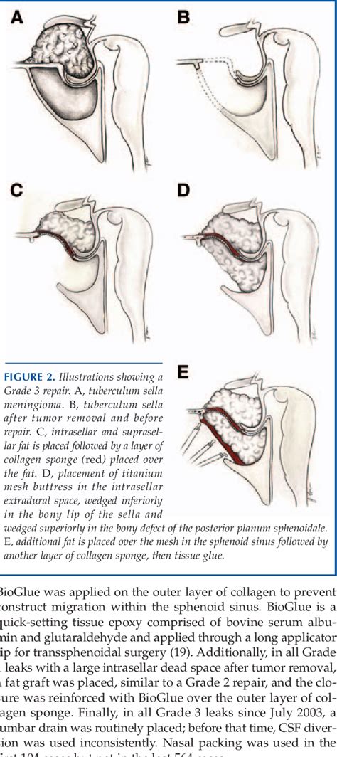 Transsphenoidal Surgery | Semantic Scholar