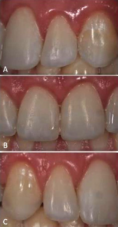 A Right Lateral View Of The Teeth Restored B Frontal View The Teeth