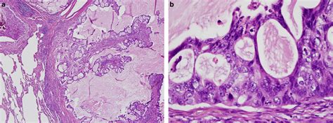 Lung Mucinous Adenocarcinoma With Prominent Cribriform Spaces Are Seen