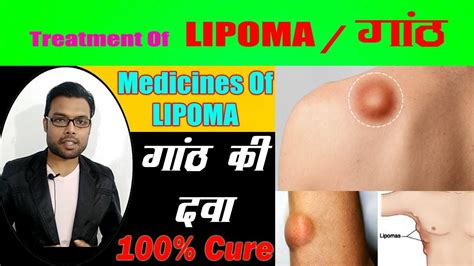 गठ क इलज Lipoma Ayurvedic treatment Lipoma ka ilaj Medicines