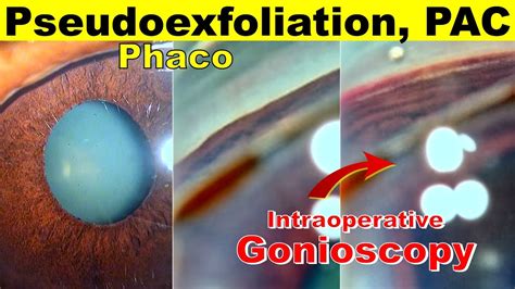 Cataract Surgery In An Eye With Pseudoexfoliation And Primary Angle