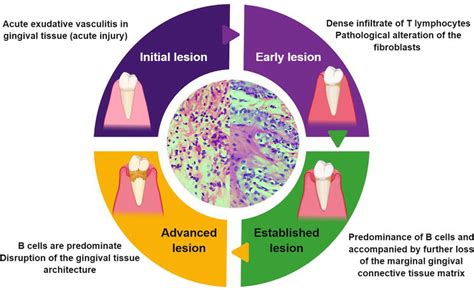 Pathogenesis Of Periodontal Disease Intechopen