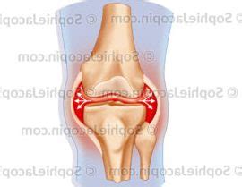 Hémarthrose du genou symptômes causes et traitements eln voces