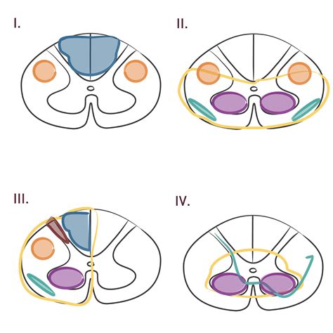 Neuroanatomy Glossary Spinal Cord Disorders Overview Draw It To