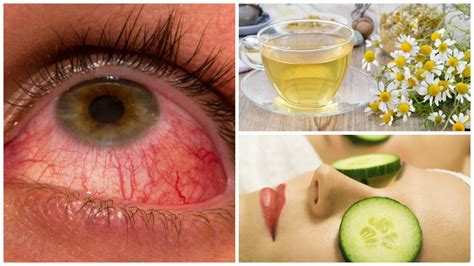 Alivia La Conjuntivitis Con Estos 6 Remedios Naturales Remedios Para