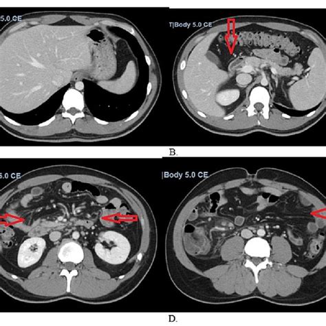 Ct Of The Abdomen And Pelvis With Intravenous Contrast Download Scientific Diagram