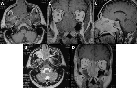 [a] T1 Weighted Mri Axial And [b] T2 Wi Expransive Solid Lesion