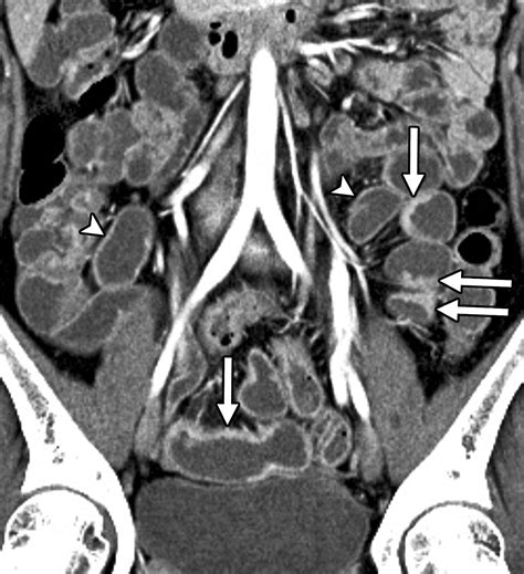 Small Bowel Crohn Disease At Ct And Mr Enterography Imaging Atlas And