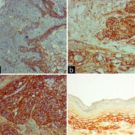 Photomicrograph Showing Expression Of Cd In Lesion Proper Of