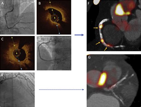 The Clinical Utility Of Hybrid Imaging For The Identification Of