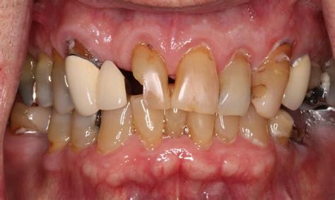 Before After Photos Lanap Laser Periodontal Treatment Gallery