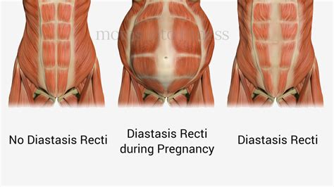 Running With Diastasis Recti How To Run Safely Moms Into Fitness