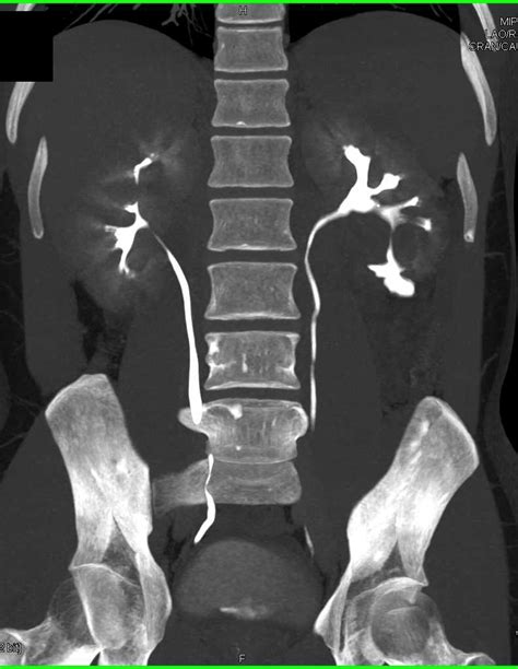 Tuberous Sclerosis With Multiple Bilateral Renal Angiomyolipomas