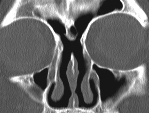 Failed Endoscopic Sinus Surgery Spectrum Of Ct Findings In The Frontal