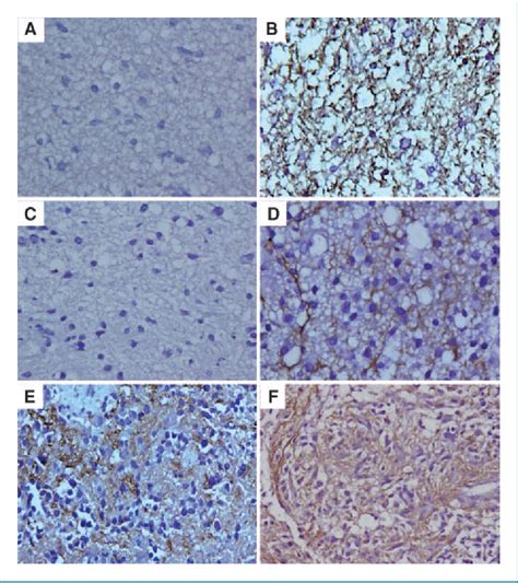 PDF Serum Osteopontin Levels Correlate With Poor Prognosis