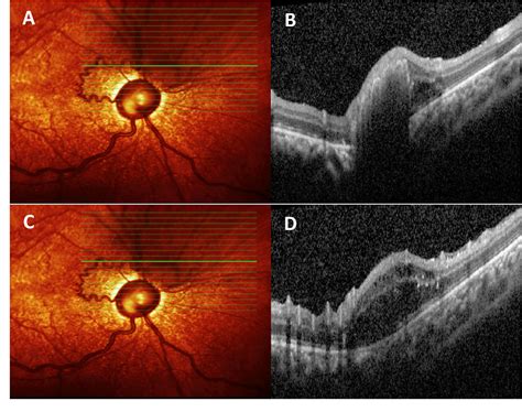 Figure 2 From Retinal Capillary Hemangioblastoma And Hemiretinal Vein Occlusion In A Patient