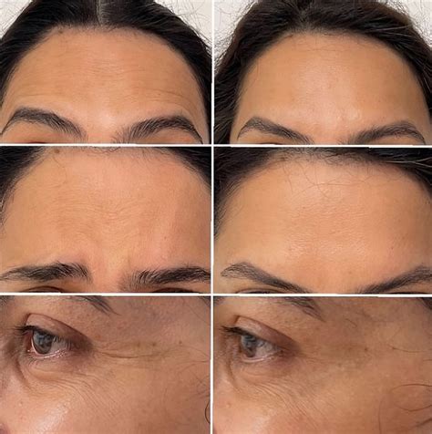 Anti Wrinkle Injections Whittlesea Smiles