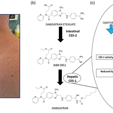 A Non‐follicular Sterile Pustules On An Erythematous Base That