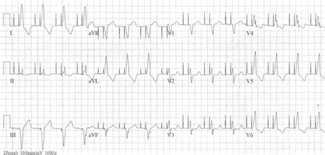 Pacemaker Rhythms Normal Patterns • Litfl • Ecg Library Diagnosis