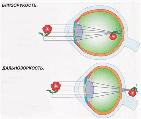 Как возникают близорукость и дальнозоркость, кратко