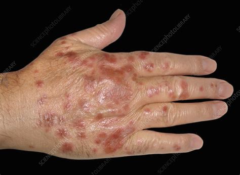 Erythema Multiforme Hands