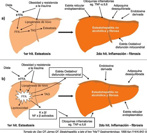 Enfermedad Hepática Grasa No Alcohólica Tendencias En