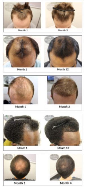 Thinning Hair Crown Men