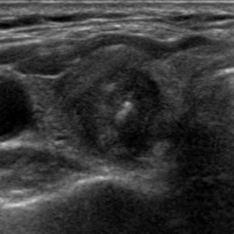 A 59 Year Old Woman With A Papillary Thyroid Carcinoma Showing A