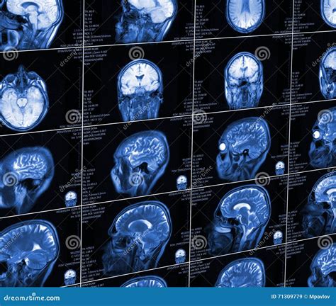 Magnetic Resonance Imaging Of The Brain Stock Illustration