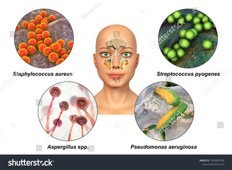 Anatomy Rhinosinusitis Bacteria That Cause Sinusitis Stock Illustration