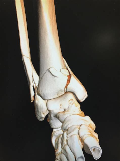 Tibial Plafond Fractures Trauma Orthobullets