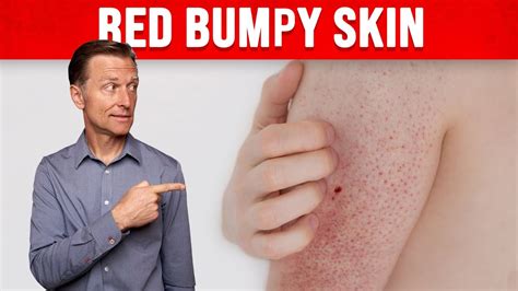 1 Perfect Remedy For Keratosis Pilaris Chicken Skin Youtube