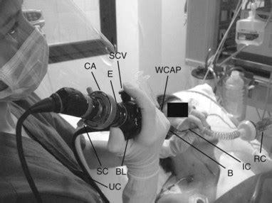 Fiberoptic Bronchoscopy | Anesthesia Key