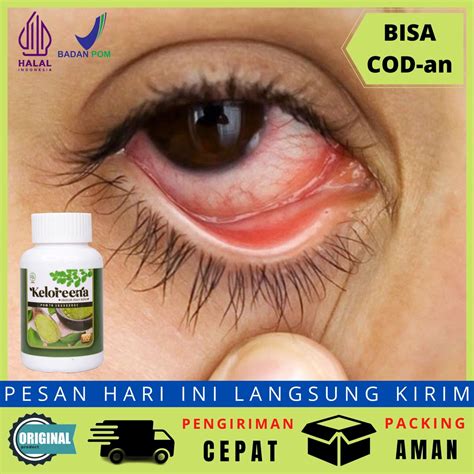 Jual Obat Mata Gatal Mata Lelah Gatal Lelah Kapsul Benjolan Berair