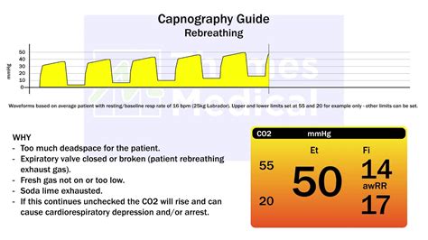 Capnography Waveforms: Rebreathing - YouTube