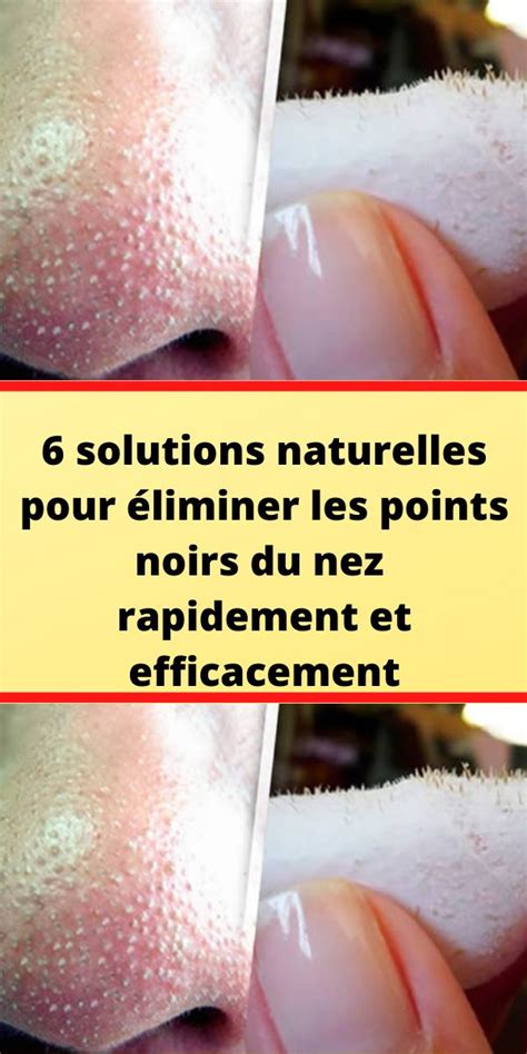 Solutions Naturelles Pour Liminer Les Points Noirs Du Nez Rapidement