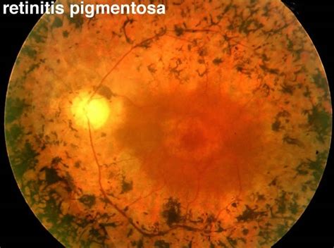 Retinitis pigmentosa causes, symptoms, diagnosis, treatment & prognosis