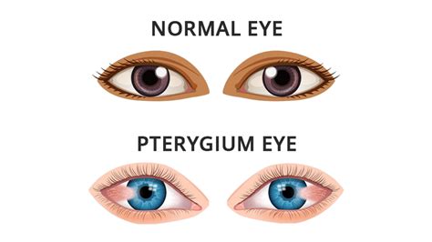 Pterygium Symptoms: Understanding, Prevention, and Treatment