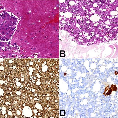 Photomicrographs From Cases And Image A Hematoxylin And Eosin