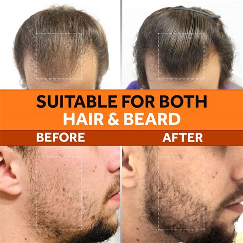 Minoxidil Before After Beard