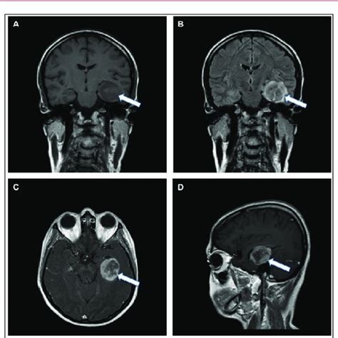 Imaging Features Of An Epithelioid Glioblastoma On An MRI Scan A