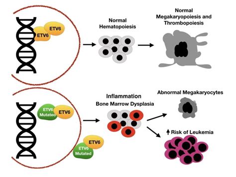 Mutations In Etv Lead To Mild Thrombocytopenia Di Paola Lab