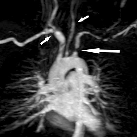 Gadolinium Enhanced Three Dimensional Mr Angiography Of Takayasu